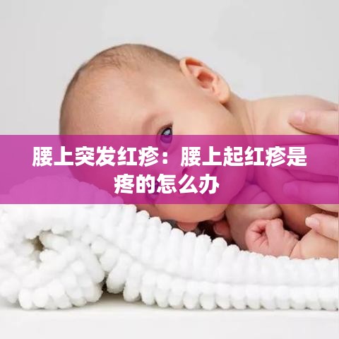腰上突发红疹：腰上起红疹是疼的怎么办 