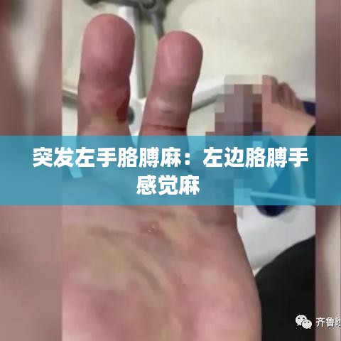 突发左手胳膊麻：左边胳膊手感觉麻 