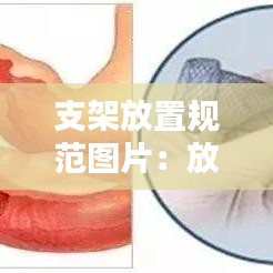 支架放置规范图片：放支架技术要求 