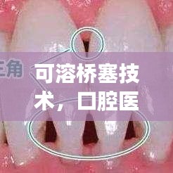 可溶桥塞技术，口腔医疗革新详解