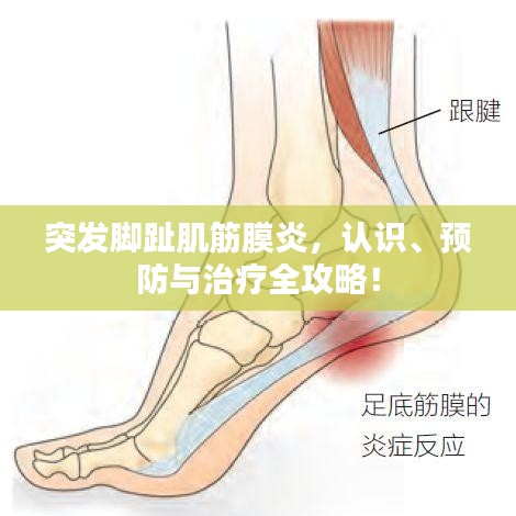 突发脚趾肌筋膜炎，认识、预防与治疗全攻略！